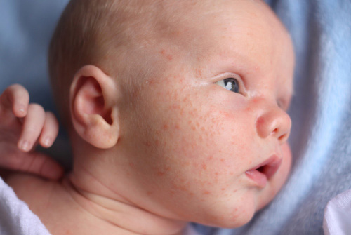 Antioxidant Nutrients and Atopic Dermatitis in Children